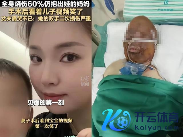 被烧伤女子为调理剪发发 丈夫也剪发 患难见真情